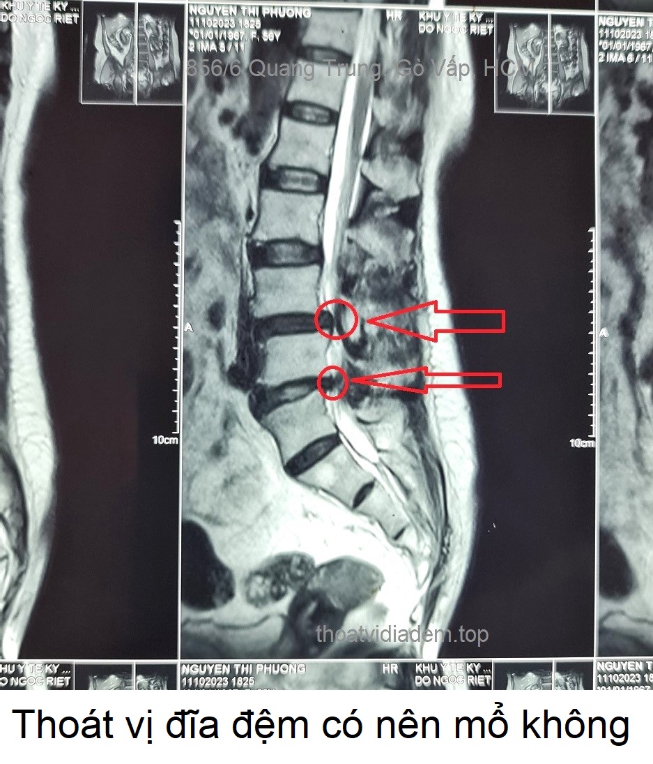 Thoát vị đĩa đệm có nên mổ không